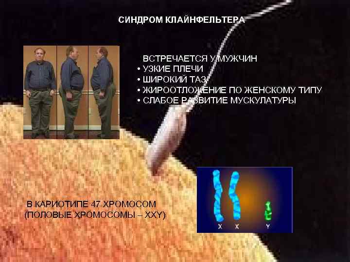 СИНДРОМ КЛАЙНФЕЛЬТЕРА • ВСТРЕЧАЕТСЯ У МУЖЧИН • УЗКИЕ ПЛЕЧИ • ШИРОКИЙ ТАЗ • ЖИРООТЛОЖЕНИЕ