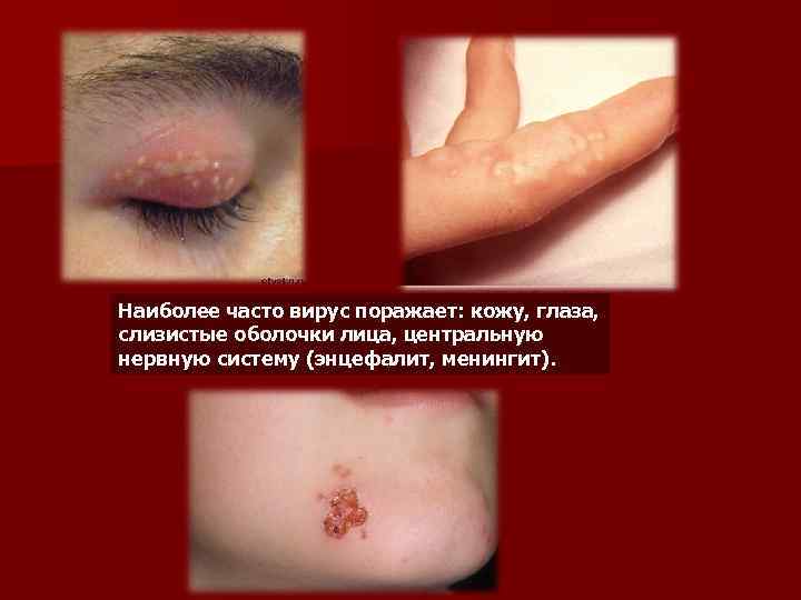 Наиболее часто вирус поражает: кожу, глаза, слизистые оболочки лица, центральную нервную систему (энцефалит, менингит).