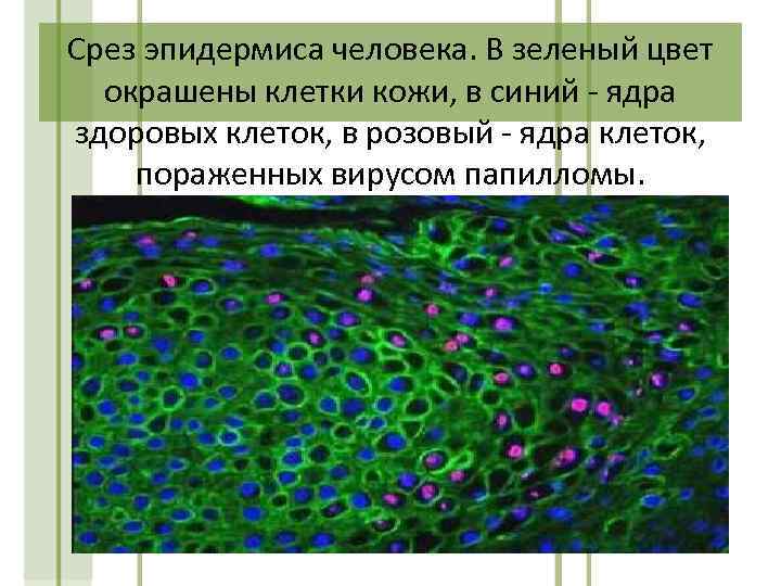 Срез эпидермиса человека. В зеленый цвет окрашены клетки кожи, в синий - ядра здоровых