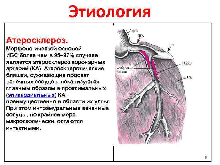 Этиология Атеросклероз. Морфологической основой ИБС более чем в 95– 97% случаев является атеросклероз коронарных