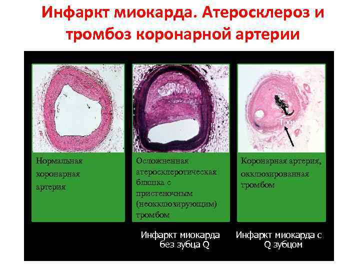 Инфаркт миокарда. Атеросклероз и тромбоз коронарной артерии Тромб Нормальная коронарная артерия Осложненная атеросклеротическая бляшка