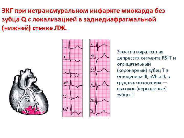 ЭКГ при нетрансмуральном инфаркте миокарда без зубца Q с локализацией в заднедиафрагмальной (нижней) стенке