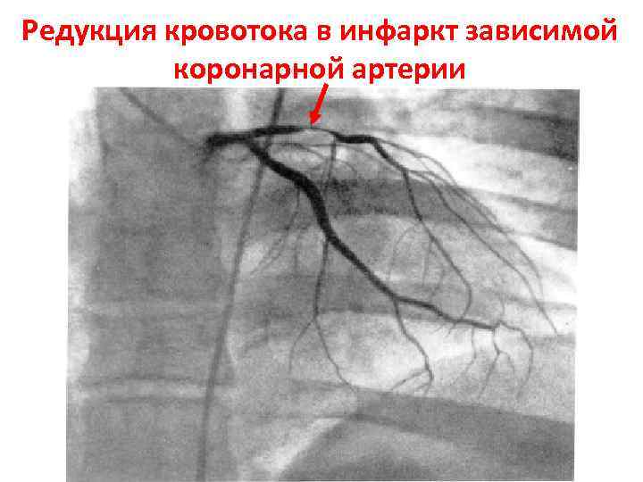 Редукция кровотока в инфаркт зависимой коронарной артерии 