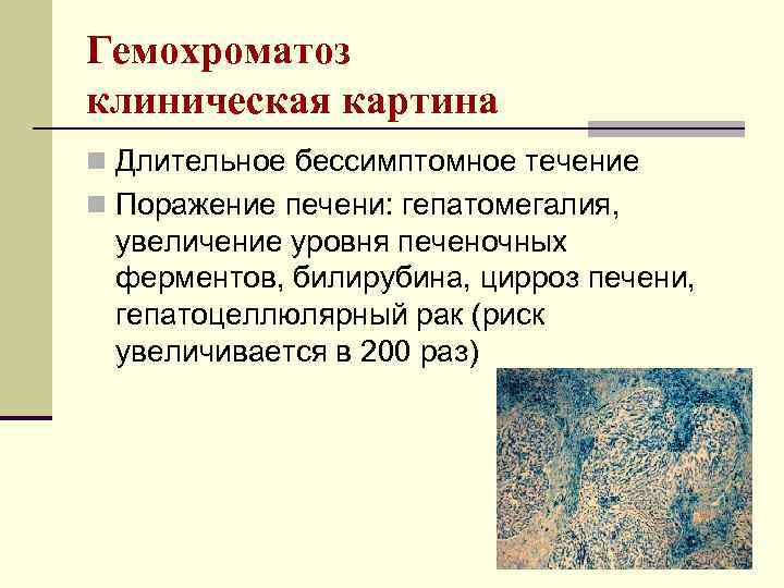 Гемохроматоз клиническая картина n Длительное бессимптомное течение n Поражение печени: гепатомегалия, увеличение уровня печеночных