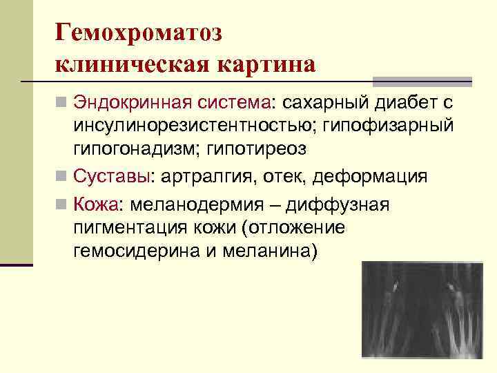 Гемохроматоз клиническая картина n Эндокринная система: сахарный диабет с инсулинорезистентностью; гипофизарный гипогонадизм; гипотиреоз n