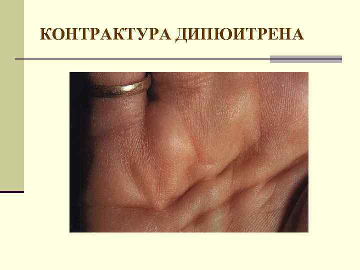 КОНТРАКТУРА ДИПЮИТРЕНА 