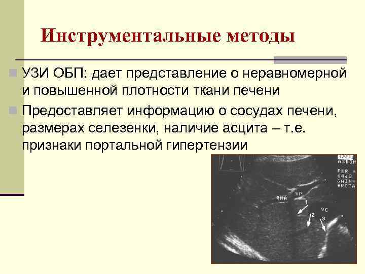 Инструментальные методы n УЗИ ОБП: дает представление о неравномерной и повышенной плотности ткани печени