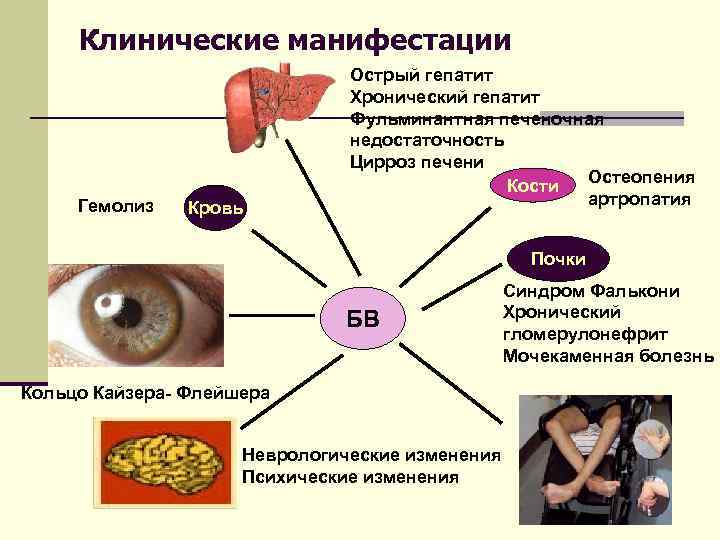 Клинические манифестации Гемолиз Кровь Острый гепатит Хронический гепатит Фульминантная печеночная недостаточность Цирроз печени Остеопения