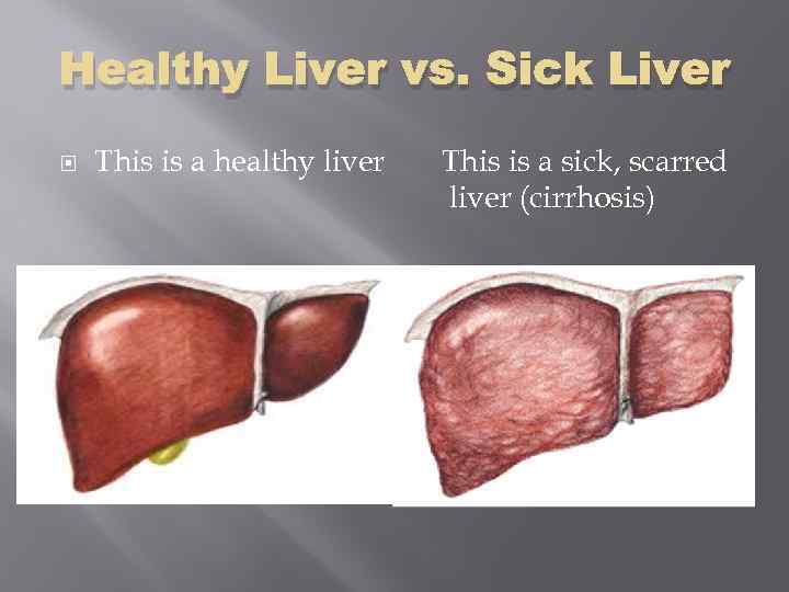 Healthy Liver vs. Sick Liver This is a healthy liver This is a sick,