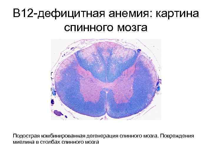 В 12 -дефицитная анемия: картина спинного мозга Подострая комбинированная дегенерация спинного мозга. Повреждения миелина