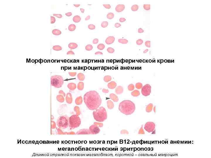 Морфологическая картина периферической крови при макроцитарной анемии Исследование костного мозга при В 12 -дефицитной