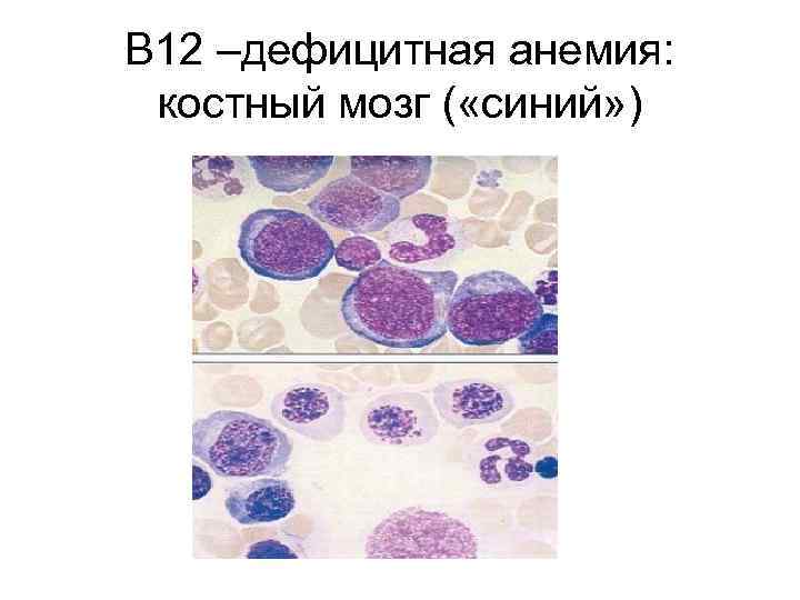 В 12 –дефицитная анемия: костный мозг ( «синий» ) 