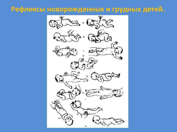 Рефлексы новорожденных и грудных детей. 