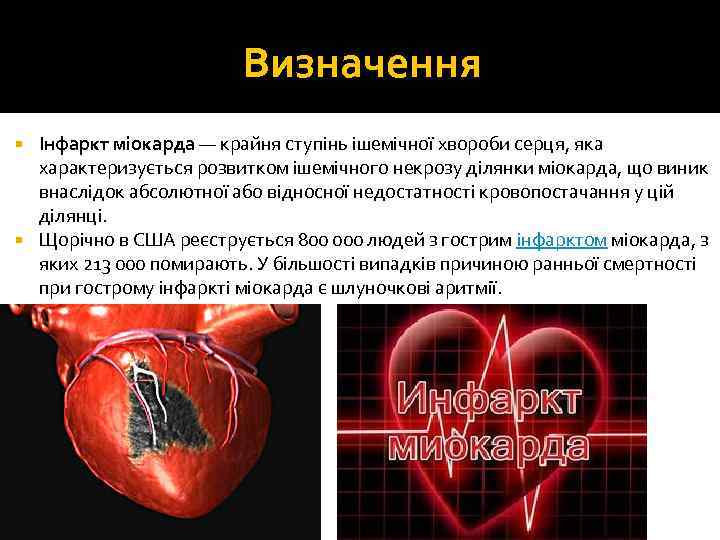 Визначення Інфаркт міокарда — крайня ступінь ішемічної хвороби серця, яка характеризується розвитком ішемічного некрозу