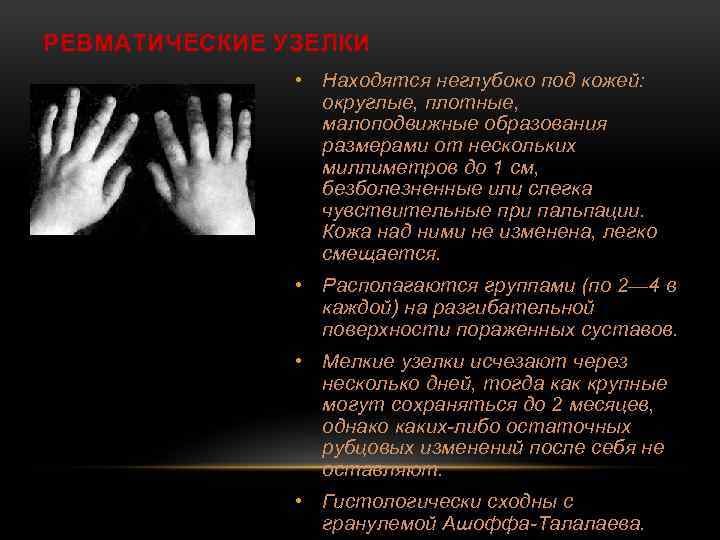 РЕВМАТИЧЕСКИЕ УЗЕЛКИ • Находятся неглубоко под кожей: округлые, плотные, малоподвижные образования размерами от нескольких