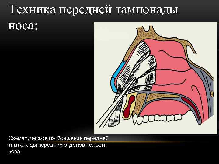 Техника передней тампонады носа: Схематическое изображение передней тампонады передних отделов полости носа. 