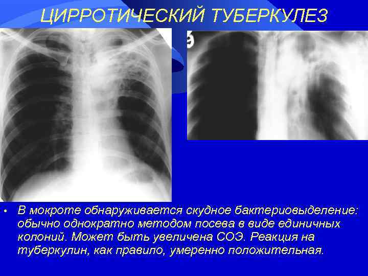 ЦИРРОТИЧЕСКИЙ ТУБЕРКУЛЕЗ • В мокроте обнаруживается скудное бактериовыделение: обычно однократно методом посева в виде