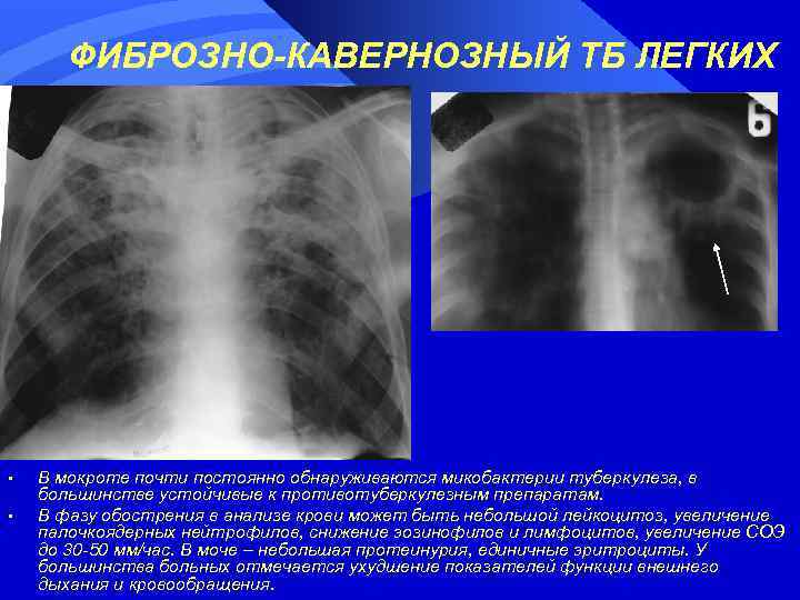 ФИБРОЗНО-КАВЕРНОЗНЫЙ ТБ ЛЕГКИХ • • В мокроте почти постоянно обнаруживаются микобактерии туберкулеза, в большинстве