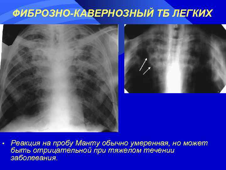 ФИБРОЗНО-КАВЕРНОЗНЫЙ ТБ ЛЕГКИХ • Реакция на пробу Манту обычно умеренная, но может быть отрицательной