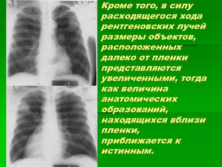 Кроме того, в силу расходящегося хода рентгеновских лучей размеры объектов, расположенных далеко от пленки