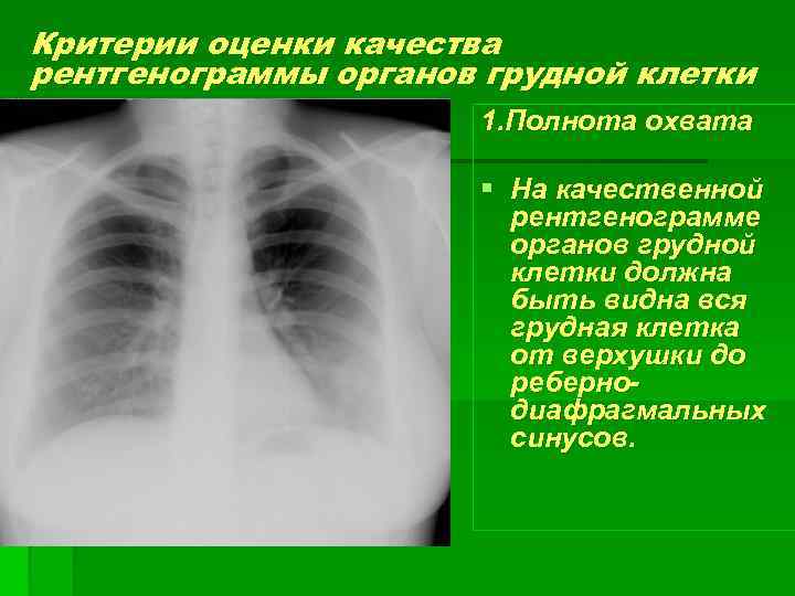 Критерии оценки качества рентгенограммы органов грудной клетки 1. Полнота охвата § На качественной рентгенограмме