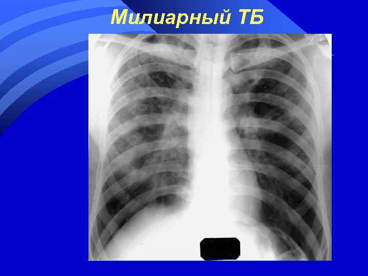 Милиарный ТБ 