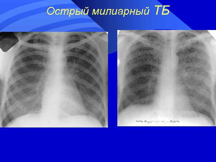 Острый милиарный ТБ 