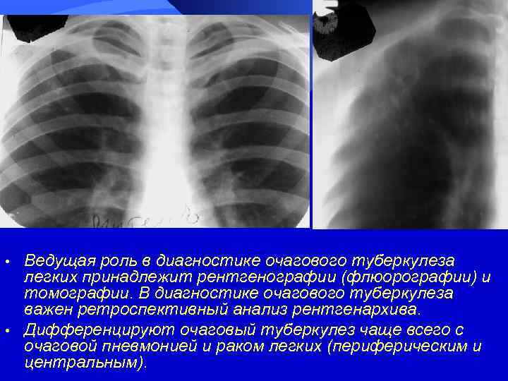  • • Ведущая роль в диагностике очагового туберкулеза легких принадлежит рентгенографии (флюорографии) и
