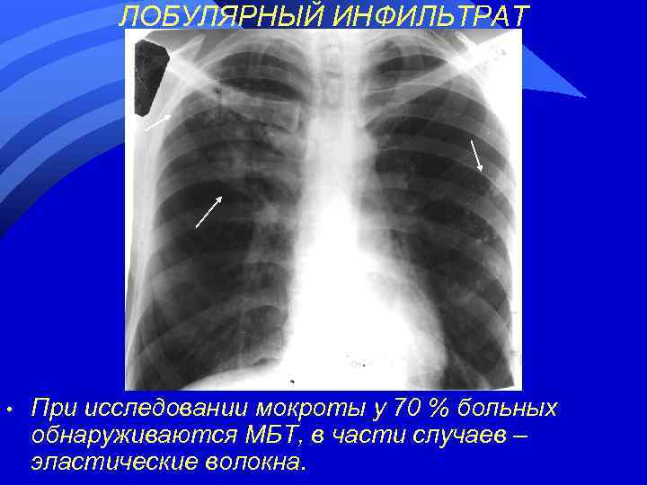 ЛОБУЛЯРНЫЙ ИНФИЛЬТРАТ • При исследовании мокроты у 70 % больных обнаруживаются МБТ, в части
