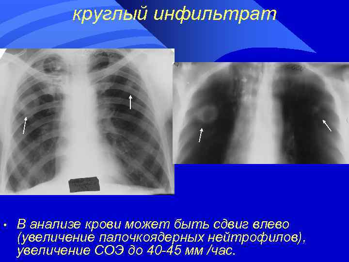 круглый инфильтрат • В анализе крови может быть сдвиг влево (увеличение палочкоядерных нейтрофилов), увеличение