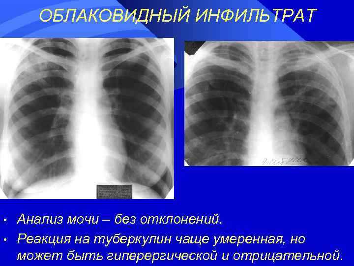 ОБЛАКОВИДНЫЙ ИНФИЛЬТРАТ • • Анализ мочи – без отклонений. Реакция на туберкулин чаще умеренная,