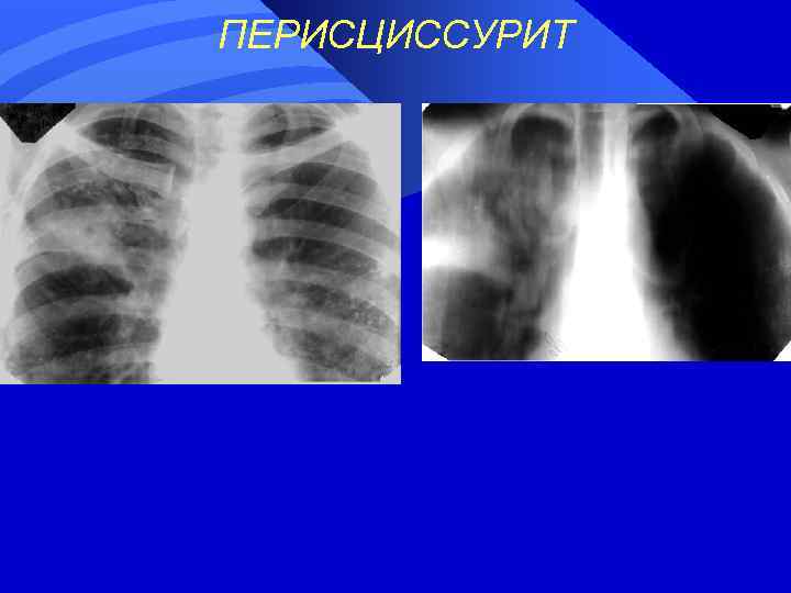 ПЕРИСЦИССУРИТ 