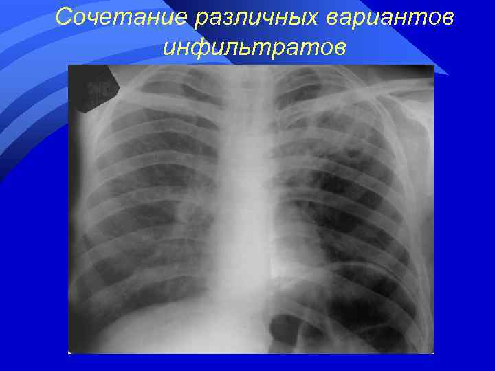 Сочетание различных вариантов инфильтратов 