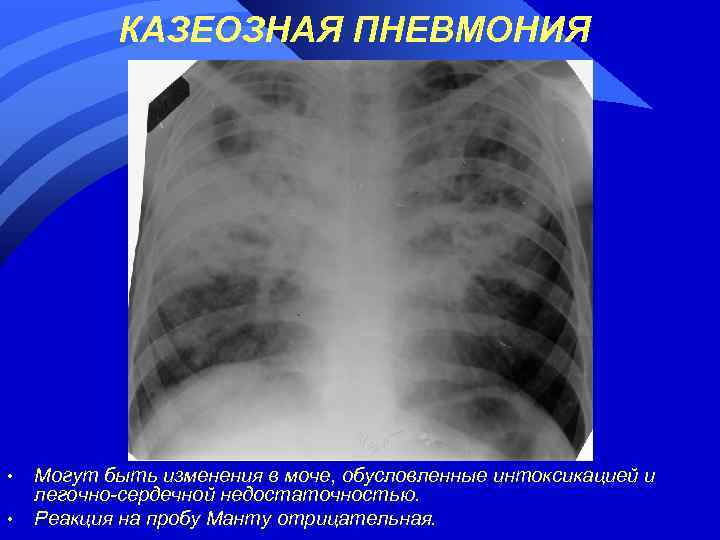 КАЗЕОЗНАЯ ПНЕВМОНИЯ • • Могут быть изменения в моче, обусловленные интоксикацией и легочно-сердечной недостаточностью.