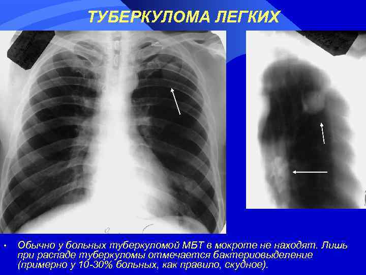 ТУБЕРКУЛОМА ЛЕГКИХ • Обычно у больных туберкуломой МБТ в мокроте не находят. Лишь при