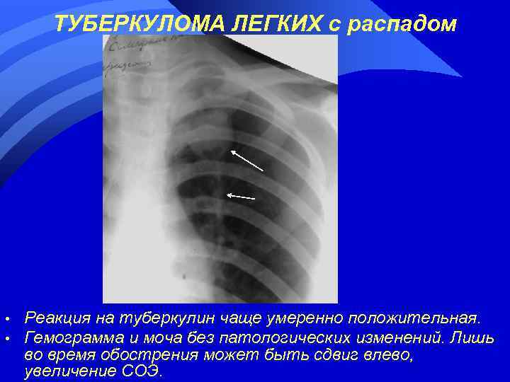 ТУБЕРКУЛОМА ЛЕГКИХ с распадом • • Реакция на туберкулин чаще умеренно положительная. Гемограмма и