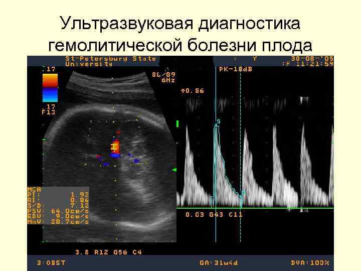 Ультразвуковая диагностика гемолитической болезни плода 