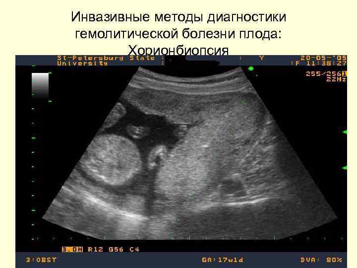 Инвазивные методы диагностики гемолитической болезни плода: Хорионбиопсия 