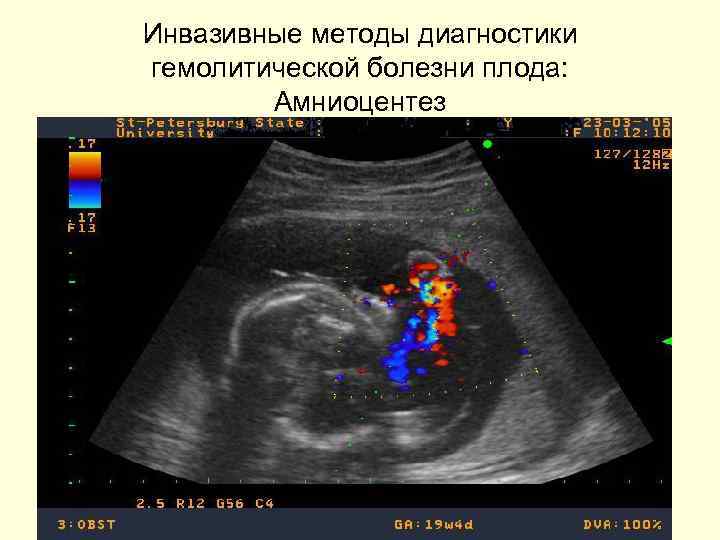 Инвазивные методы диагностики гемолитической болезни плода: Амниоцентез 