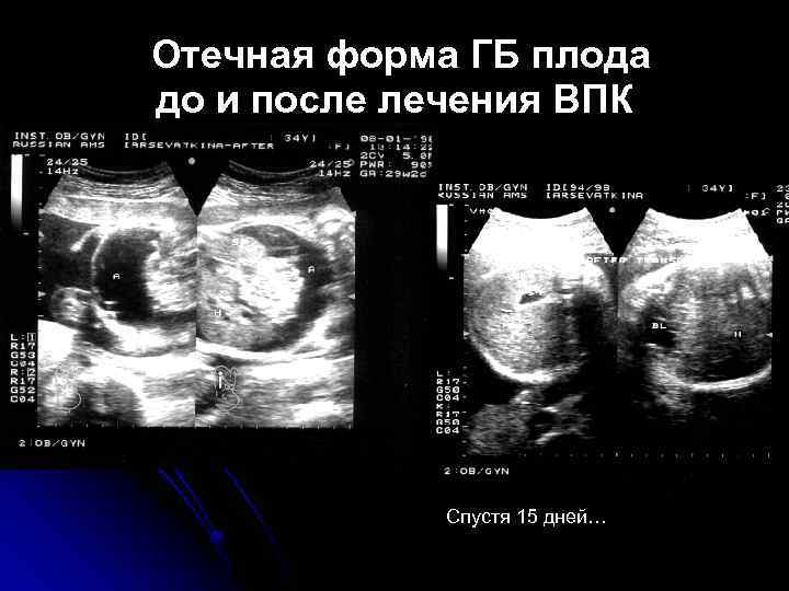 Отечная форма ГБ плода до и после лечения ВПК Спустя 15 дней… 