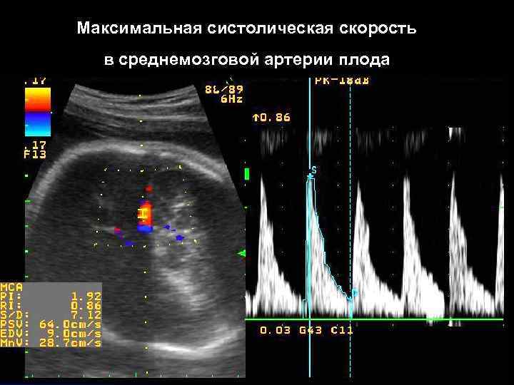Максимальная систолическая скорость в среднемозговой артерии плода 