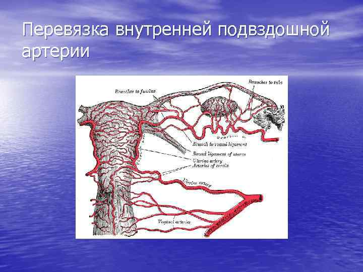 Перевязка внутренней подвздошной артерии 