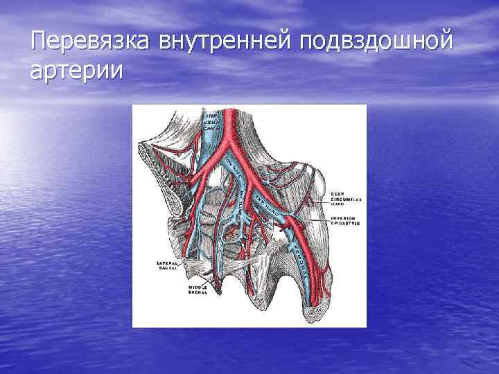 Перевязка внутренней подвздошной артерии 