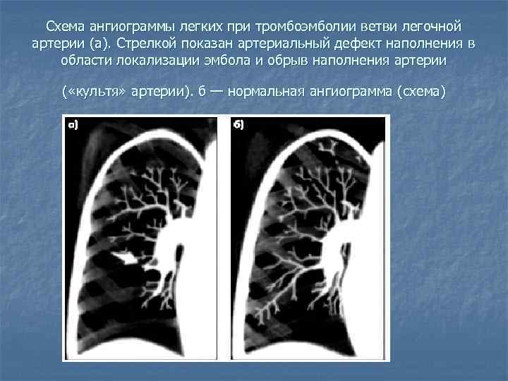 Схема ангиограммы легких при тромбоэмболии ветви легочной артерии (а). Стрелкой показан артериальный дефект наполнения