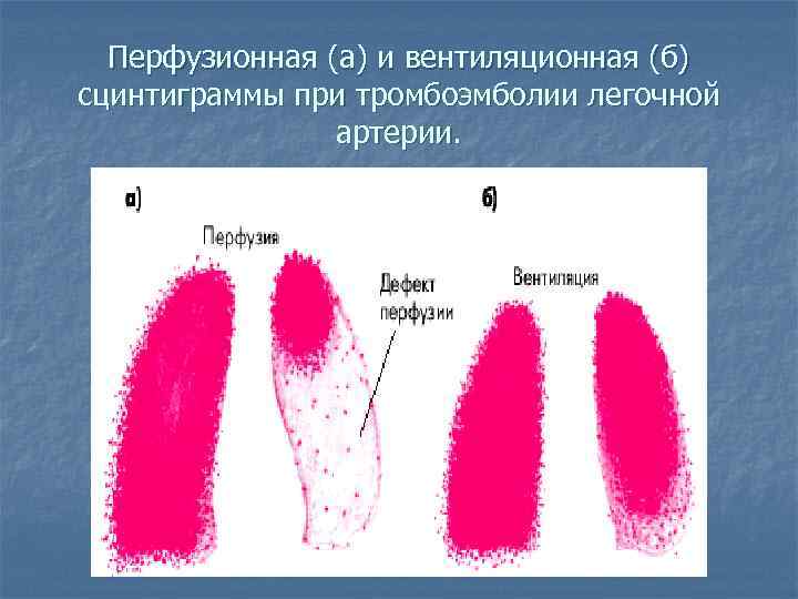 Перфузионная (а) и вентиляционная (б) сцинтиграммы при тромбоэмболии легочной артерии. 