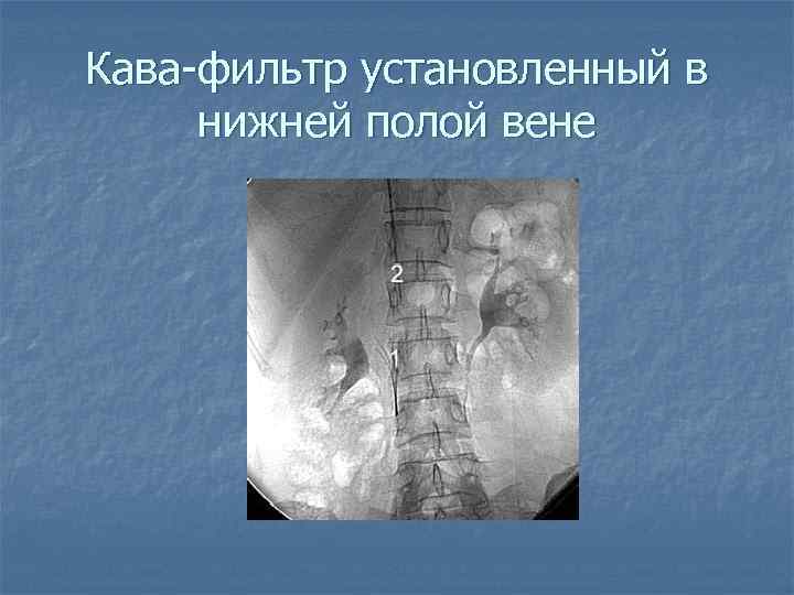 Кава-фильтр установленный в нижней полой вене 