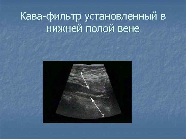 Кава-фильтр установленный в нижней полой вене 