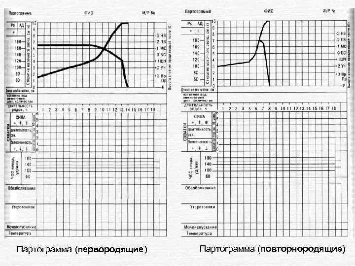 Партограмма (первородящие) Партограмма (повторнородящие) 