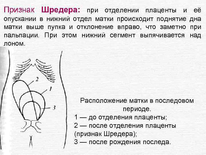 Признак Шредера: при отделении плаценты и её опускании в нижний отдел матки происходит поднятие