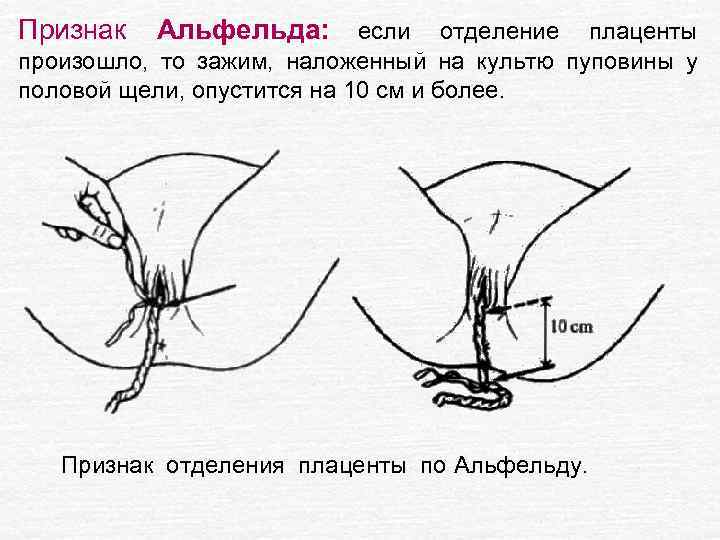 Признак Альфельда: если отделение плаценты произошло, то зажим, наложенный на культю пуповины у половой